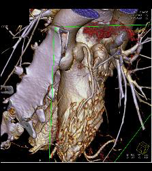 Normal VRT of Coronary Arteries and MIP as Well - CTisus CT Scan