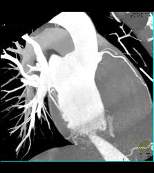 Normal VRT of Coronary Arteries and MIP as Well - CTisus CT Scan