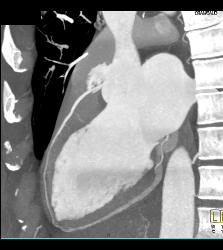 Normal VRT of Coronary Arteries and MIP as Well - CTisus CT Scan