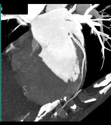 Normal VRT of Coronary Arteries and MIP as Well - CTisus CT Scan