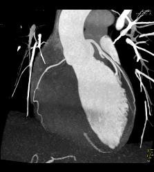 Normal VRT of Coronary Arteries and MIP as Well - CTisus CT Scan