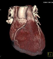 Normal VRT of Coronary Arteries and MIP as Well - CTisus CT Scan