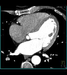 Normal VRT of Coronary Arteries and MIP as Well - CTisus CT Scan