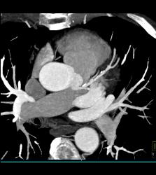 CCTA: Left Anterior Descending Coronary Artery (LAD) Disease Without Critical Stenosis - CTisus CT Scan