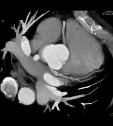 CCTA: Left Anterior Descending Coronary Artery (LAD) Disease Without Critical Stenosis - CTisus CT Scan