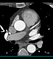 CCTA: Left Anterior Descending Coronary Artery (LAD) Disease Without Critical Stenosis - CTisus CT Scan