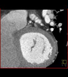 CCTA: Left Anterior Descending Coronary Artery (LAD) Disease Without Critical Stenosis - CTisus CT Scan