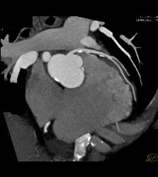 Dilated Aortic Root - CTisus CT Scan