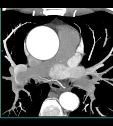 Dilated Aortic Root - CTisus CT Scan