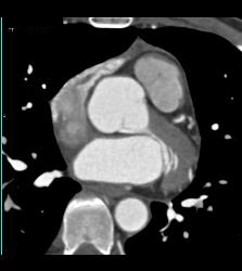 Left Anterior Descending Coronary Artery (LAD) Mixed Plaque - CTisus CT Scan