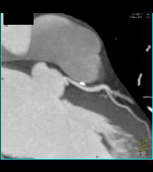 Left Anterior Descending Coronary Artery (LAD) Mixed Plaque - CTisus CT Scan