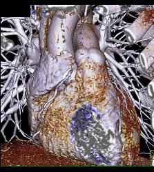 Left Anterior Descending Coronary Artery (LAD) Mixed Plaque - CTisus CT Scan