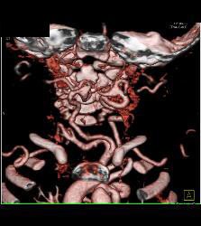 Tortuous Artery Syndrome With Small Abdominal Vessels - CTisus CT Scan