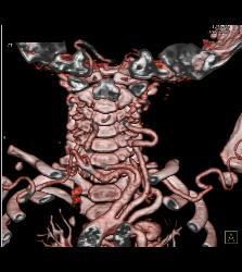 Tortuous Artery Syndrome With Small Abdominal Vessels - CTisus CT Scan