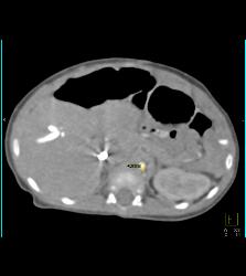 Tortuous Artery Syndrome With Small Abdominal Vessels - Cardiac Case ...