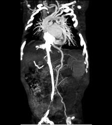 Tortuous Artery Syndrome With Small Abdominal Vessels - CTisus CT Scan