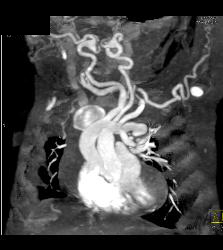 Tortuous Artery Syndrome With Small Abdominal Vessels - CTisus CT Scan