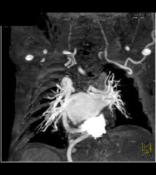 Tortuous Artery Syndrome With Small Abdominal Vessels - CTisus CT Scan