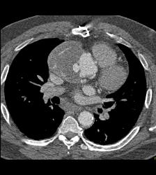 Focal Pseudo-aneurysm Ascending Aorta - CTisus CT Scan