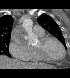 Focal Pseudo-aneurysm Ascending Aorta - CTisus CT Scan