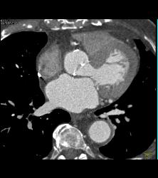 S/p CABG With Plaque in Venous Graft With 50% Stenosis- See Full Sequence. One Venous Graft Has Already Failed - CTisus CT Scan