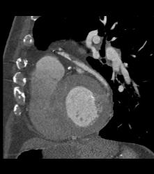 S/p CABG With Plaque in Venous Graft With 50% Stenosis- See Full Sequence. One Venous Graft Has Already Failed - CTisus CT Scan