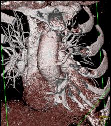 S/p CABG With Plaque in Venous Graft With 50% Stenosis- See Full Sequence. One Venous Graft Has Already Failed - CTisus CT Scan