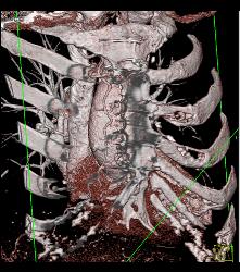 S/p CABG With Plaque in Venous Graft With 50% Stenosis- See Full Sequence. One Venous Graft Has Already Failed - CTisus CT Scan