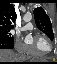 S/p CABG With Plaque in Venous Graft With 50% Stenosis- See Full Sequence. One Venous Graft Has Already Failed - CTisus CT Scan