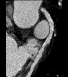 S/p CABG With Plaque in Venous Graft With 50% Stenosis- See Full Sequence. One Venous Graft Has Already Failed - CTisus CT Scan