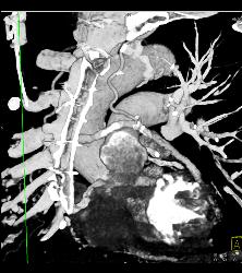 S/p CABG With Plaque in Venous Graft With 50% Stenosis- See Full Sequence. One Venous Graft Has Already Failed - CTisus CT Scan