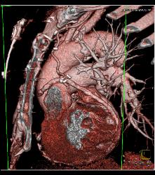 S/p CABG With Plaque in Venous Graft With 50% Stenosis- See Full Sequence. One Venous Graft Has Already Failed - CTisus CT Scan