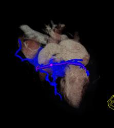 S/p CABG With Plaque in Venous Graft With 50% Stenosis- See Full Sequence. One Venous Graft Has Already Failed - CTisus CT Scan