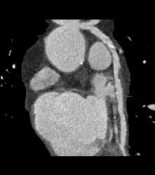 S/p CABG With Plaque in Venous Graft With 50% Stenosis- See Full Sequence. One Venous Graft Has Already Failed - CTisus CT Scan