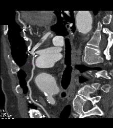 S/p CABG With Plaque in Venous Graft With 50% Stenosis- See Full Sequence. One Venous Graft Has Already Failed - CTisus CT Scan