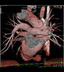 Normal Left Atrium and Pulmonary Veins - CTisus CT Scan