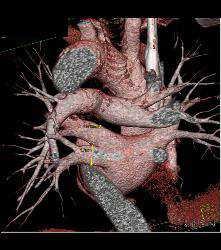 Normal Left Atrium and Pulmonary Veins - CTisus CT Scan