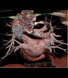 Normal Left Atrium and Pulmonary Veins - CTisus CT Scan