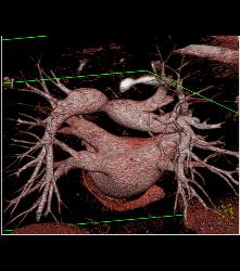 Normal Left Atrium and Pulmonary Veins - CTisus CT Scan