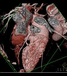 Normal RCA - CTisus CT Scan