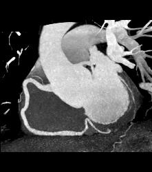 Normal RCA - CTisus CT Scan