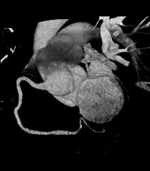 Normal RCA - CTisus CT Scan