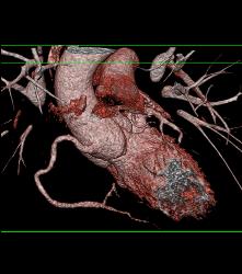 Normal RCA - CTisus CT Scan