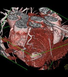 Normal Left Anterior Descending Coronary Artery (LAD) - CTisus CT Scan