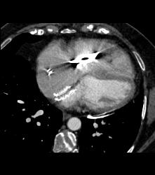 Pericardial Calcification - CTisus CT Scan