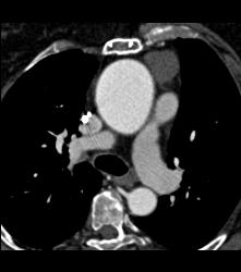 Incidental Thymoma - CTisus CT Scan