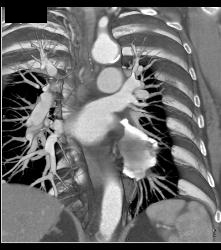 Pericardial Calcification - CTisus CT Scan