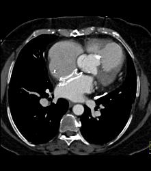 Pericardial Calcification - CTisus CT Scan