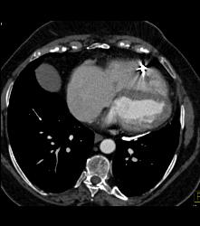 Pericardial Calcification - CTisus CT Scan