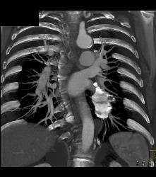 Pericardial Calcification - CTisus CT Scan